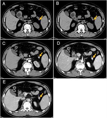 Insulinoma Presenting as a Complex Partial Seizure: Still a Possible Misleading Factor